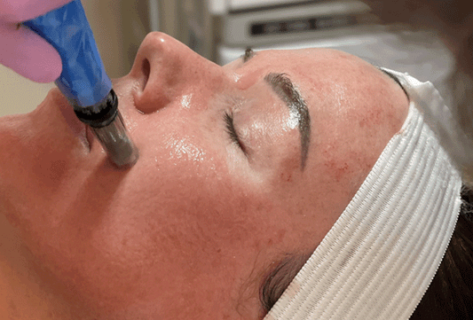 Microneedling (1 session)